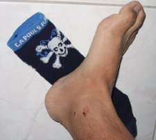 Ankle Damage - ADM Crashes at El Do - 19 AUG 2008 