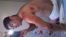 Road rash on elbow, shoulder, shoulder blade, arm - ADM Crashes at Dana Point Grand Prix - 06 May 2012