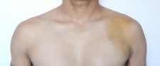 Bruised Left Shoulder - ADM Crashes at Masters Nat's - Bend, OR - 04 Sep 2012